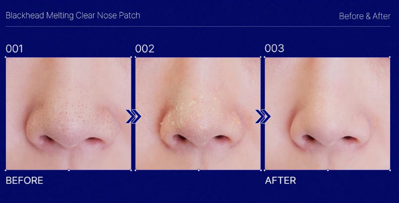 MEDIHEAL - BLACKHEAD MELTING CLEAR NOSE PATCH